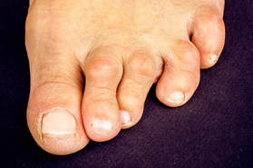 Hammer toe - foot doctor - podiatrist