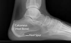heel spur - the foot doctor - podiatrist
