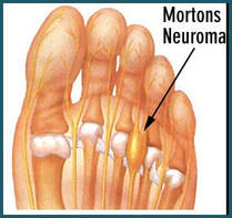 Mortons neuroma - foot doctor - podiatrist